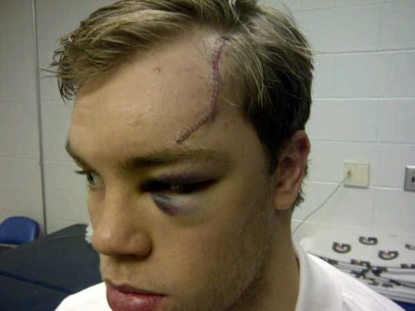 Taylor Hall Head Cut Stitches